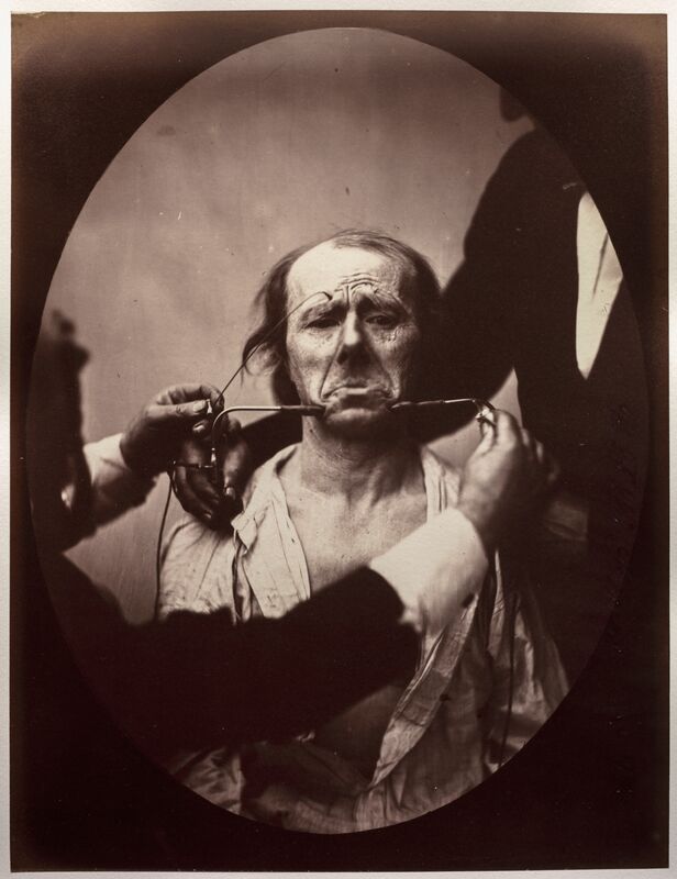 Duchenne'nin elektroşok verilen hasta fotoğrafı
